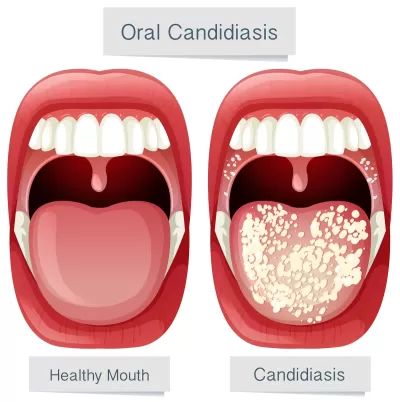 What is Oral Thrush? Understanding the Symptoms and Treatment Options