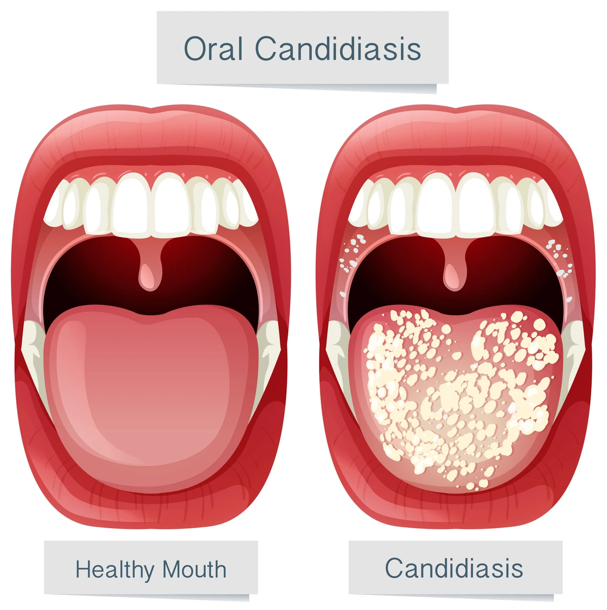What Is Oral Thrush The Symptoms And Treatment Options