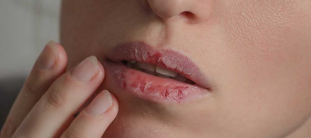 Are you suffering from dry mouth? Causes, home remedies, and treatment solutions