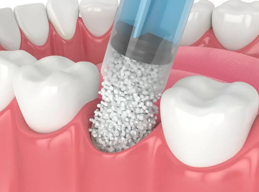 What Is The Difference Between A Bone Graft Vs A Gum Graft