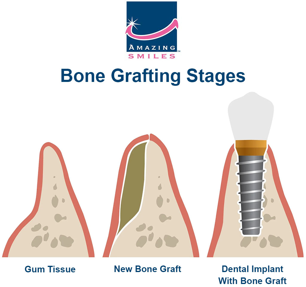 Bone Grafting Stages