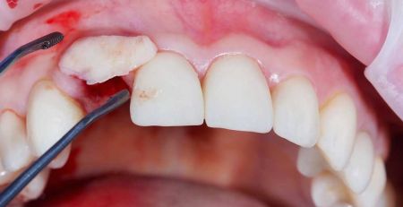Bone Grafting for Dental Implants