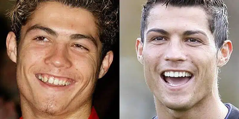 Cristiano Ronaldo - Celebrity Smile Makeovers