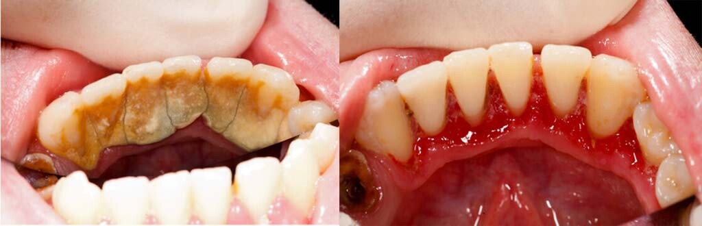 Dental Deep Clean Treatment Before And After