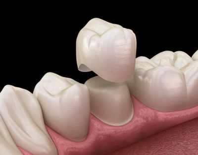 Dental Crowns a Complete Aftercare Guide