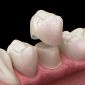 Dental Crowns a Complete Aftercare Guide