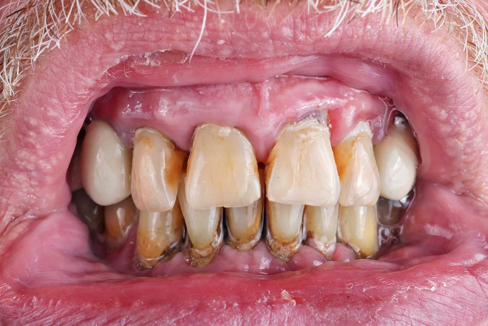 Smoking And Enamel Erosion - Amazing Smiles Dental Care