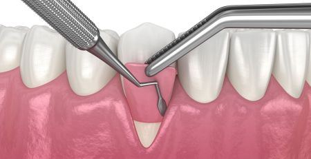 Gum Grafting for Dental Implants: What, Why, and How
