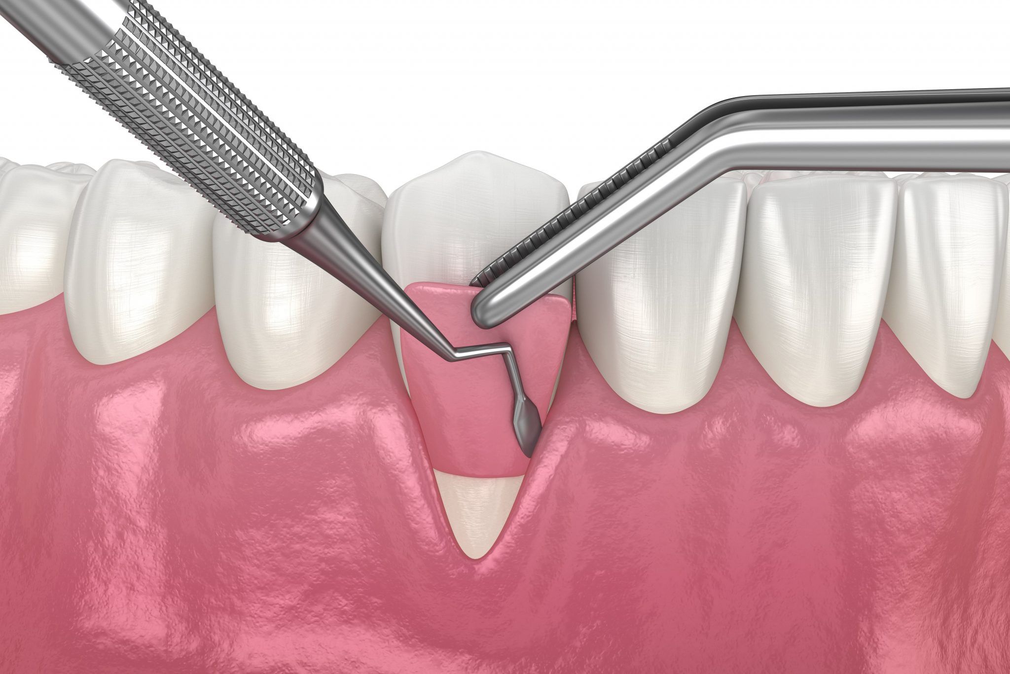 Gum Grafting for Dental Implants: What, Why, and How