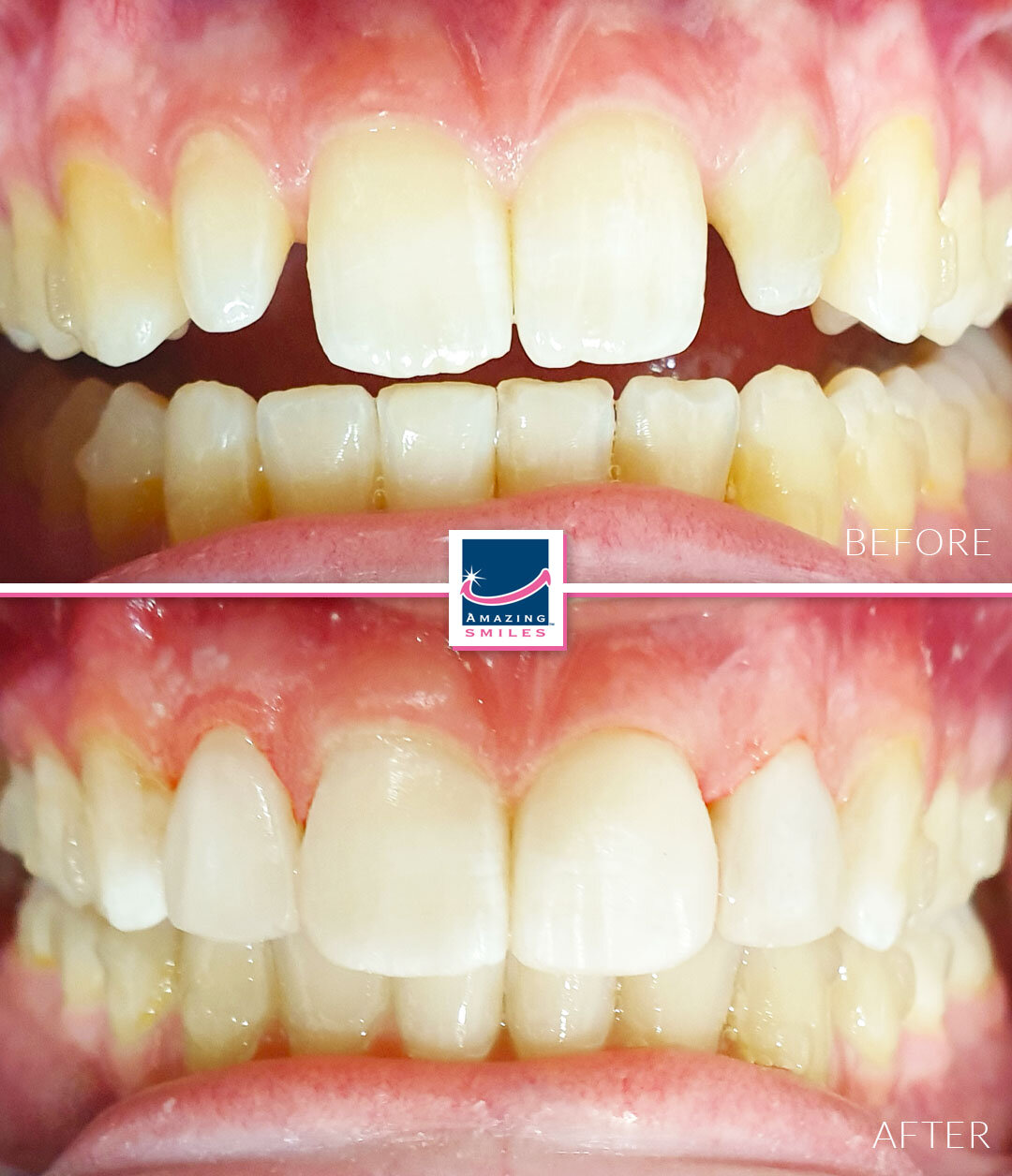 Smile Restoration - Before And After