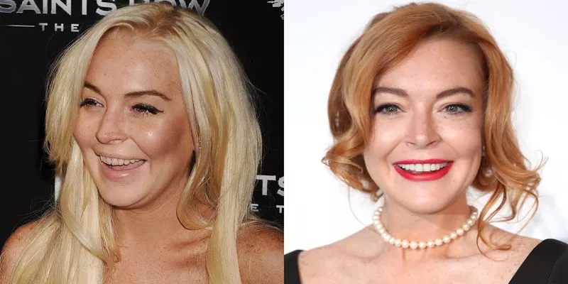 Lindsay Lohan - Celebrity Smile Makeovers