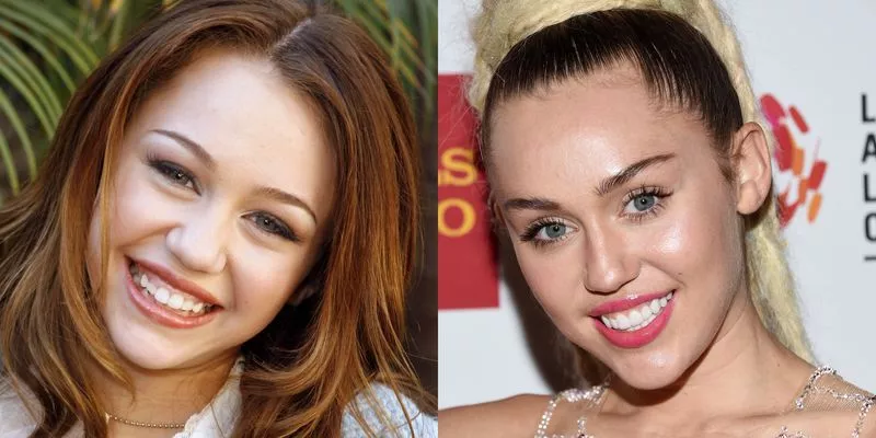 Miley Cyrus - Celebrity Smile Makeovers
