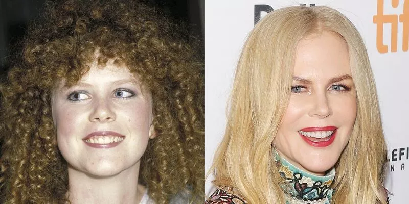 Nicole Kidman - Celebrity Smile Makeovers