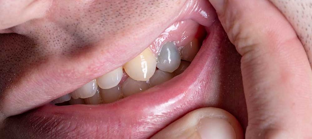 Pulp Necrosis: Understanding Causes, Symptoms, and Treatment