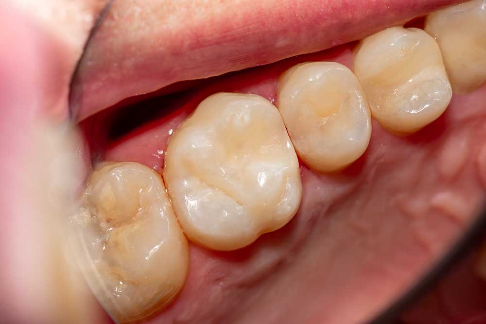 Restorative Dental Resin Fillings