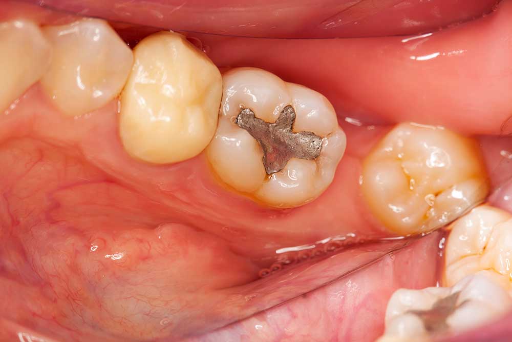 Should I Have Amalgam Fillings Replaced With Resin Fillings?