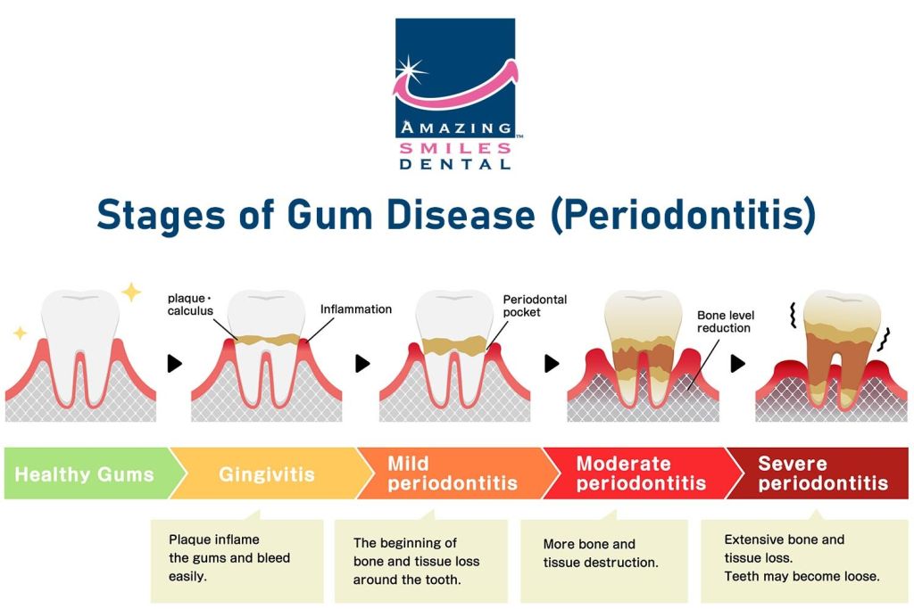 Periodontitis - Gum Disease: Symptoms, Causes, & Treatment