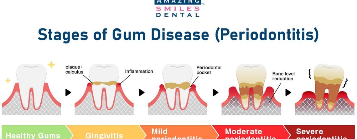 Stages of gum disease periodontitis