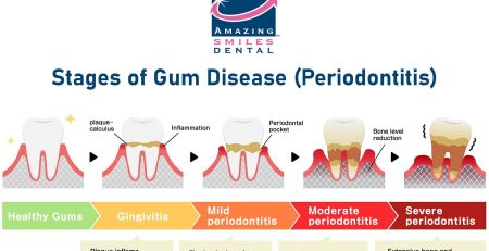 Stages of Gum Disease Periodontitis