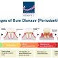 Stages of Gum Disease Periodontitis