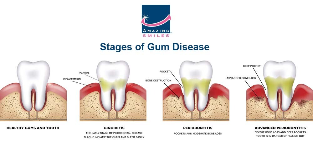 What Is Gingivitis? Symptoms, Prevention & Treatment Options