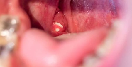 The Causes of Tonsil Stones and Treatment Options