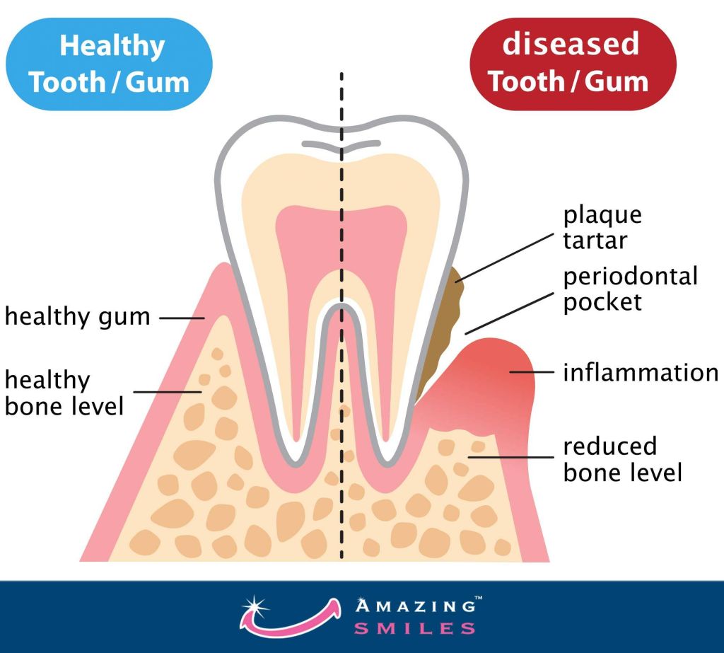 Tooth Pain Caused By Gum Disease