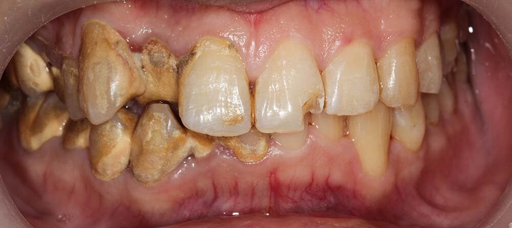 Understanding gingivitis: symptoms, prevention, and treatment options