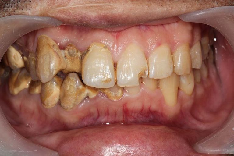 What Is Gingivitis? Symptoms, Prevention & Treatment Options