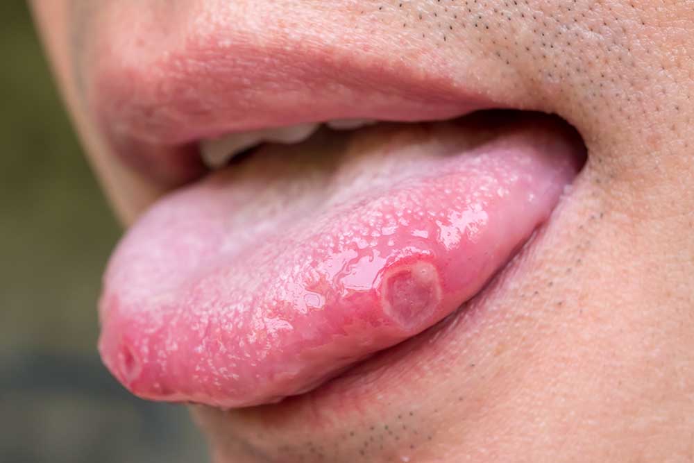 Understanding Tongue Ulcers