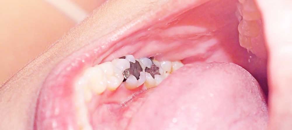 What Are Amalgam Fillings?