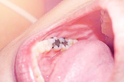 What are Amalgam Fillings?