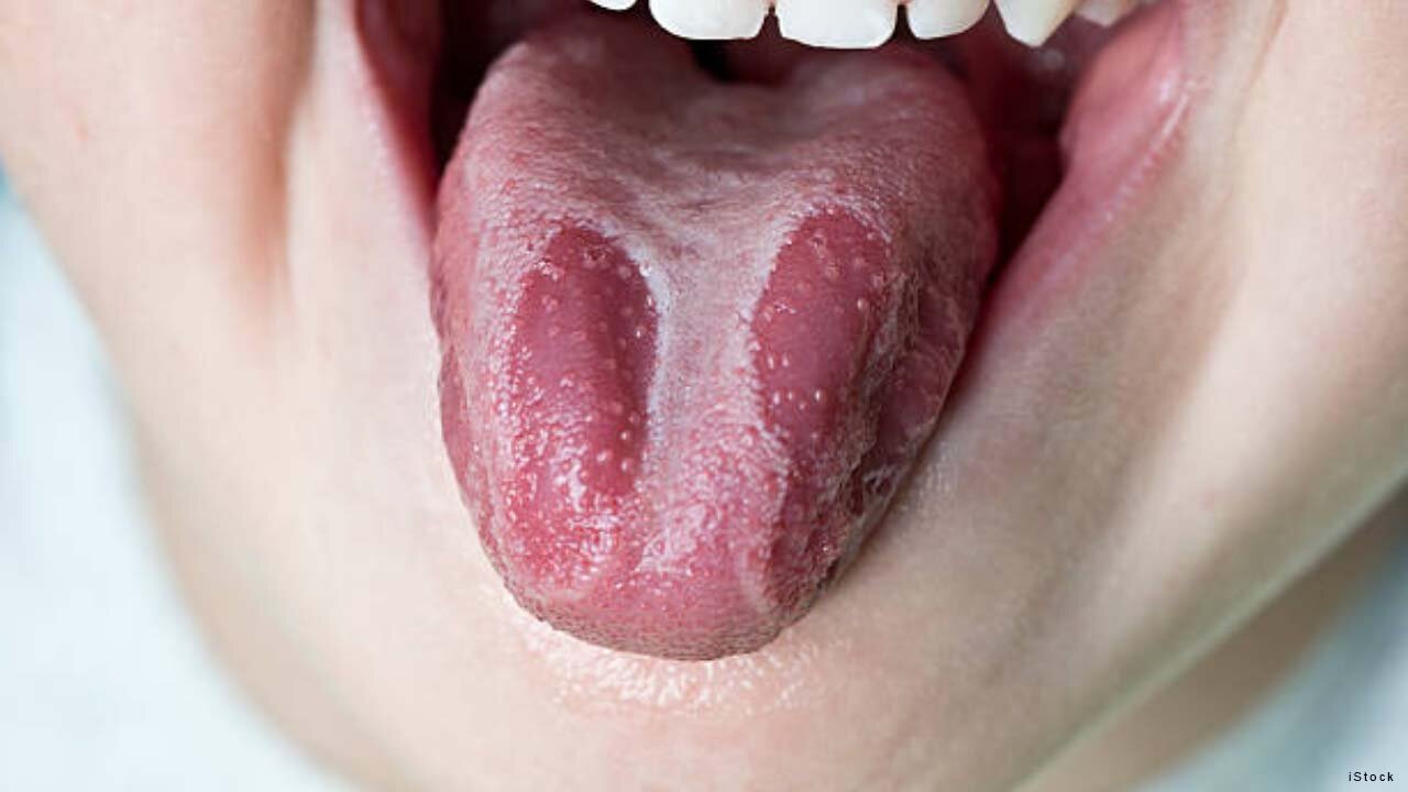 What Is Burning Mouth Syndrome