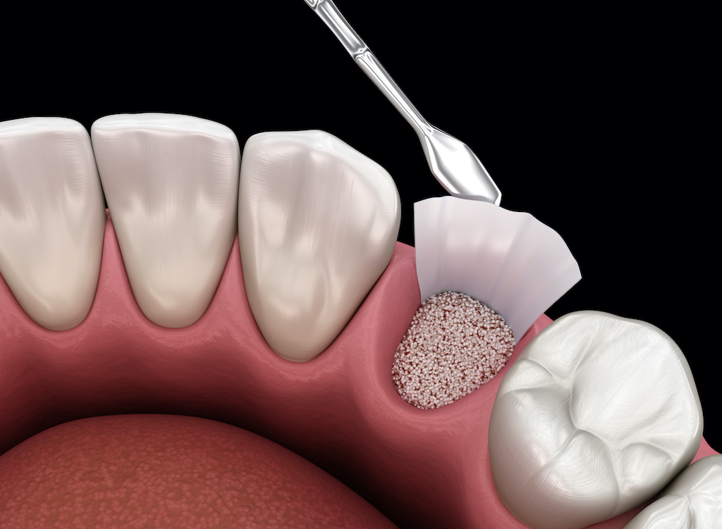 What To Expect When Getting An Oral Bone Graft For A Dental Implant?