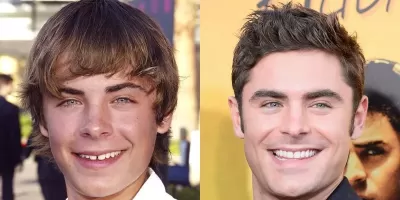 Zac Efron - Celebrity Smile Makeovers