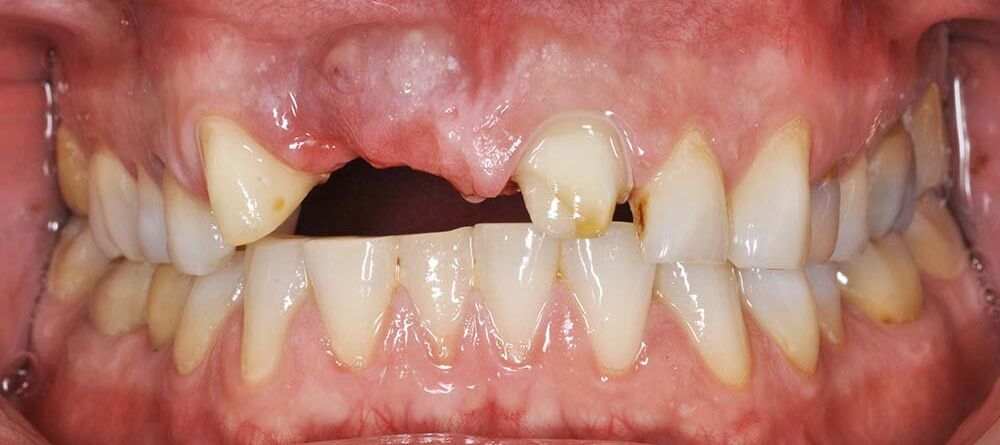 Effects of tooth loss