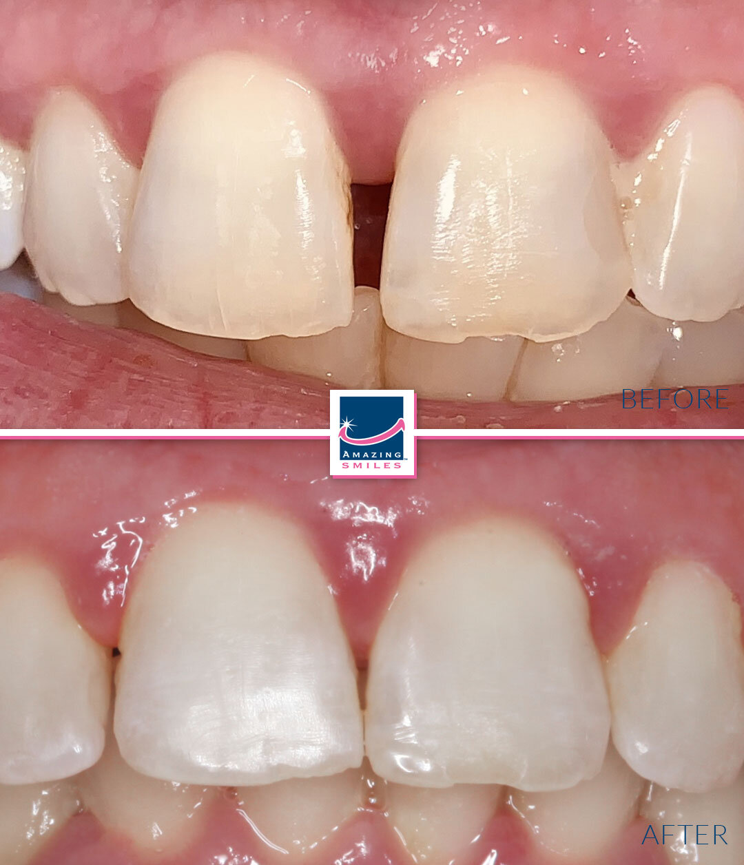 Smile Restoration - Before And After