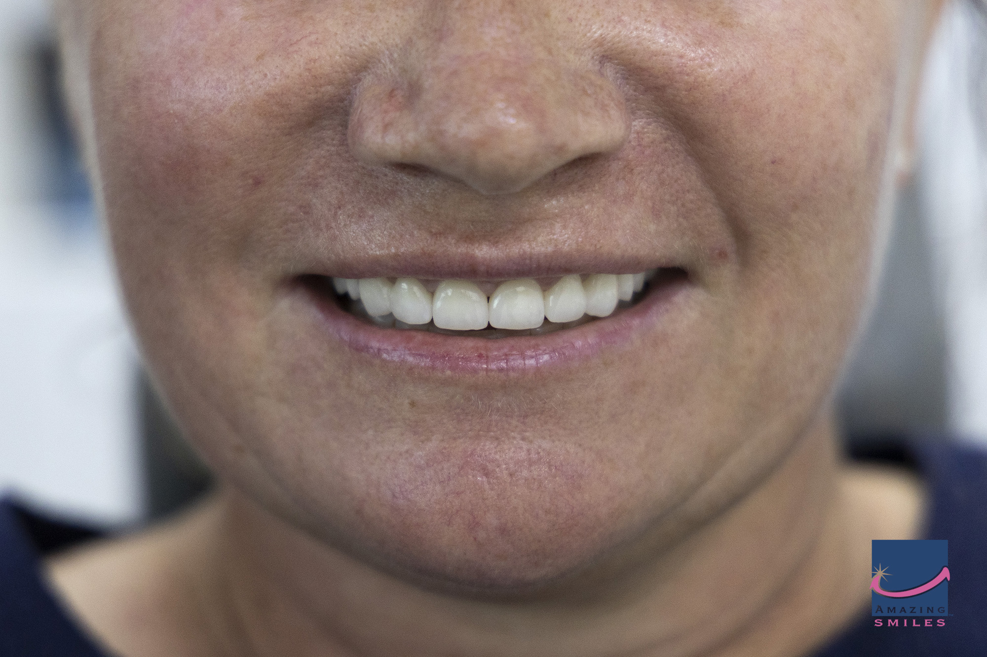 Dental Smile Makeovers