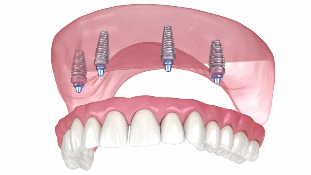 Are Dental Implants Right For You?