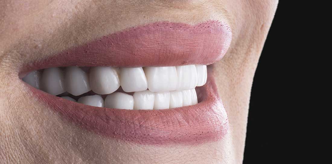 Guide To Porcelain Veneers - Benefits Of Porcelain Veneers Gold Coast And Brisbane