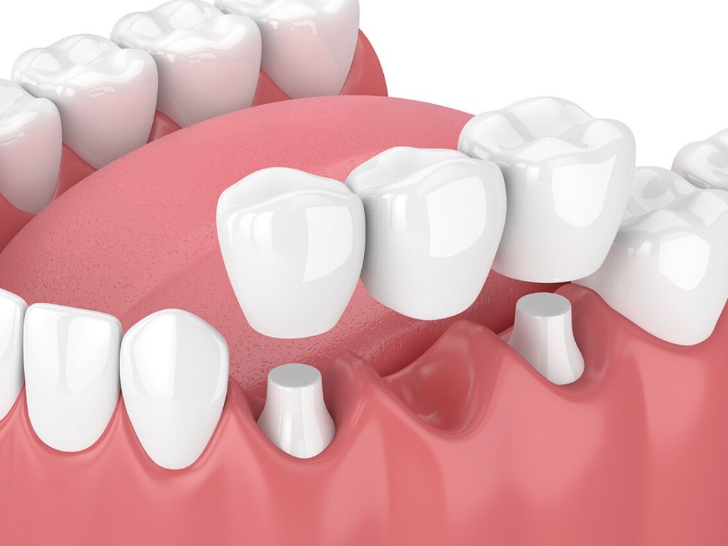 Dental Bridges