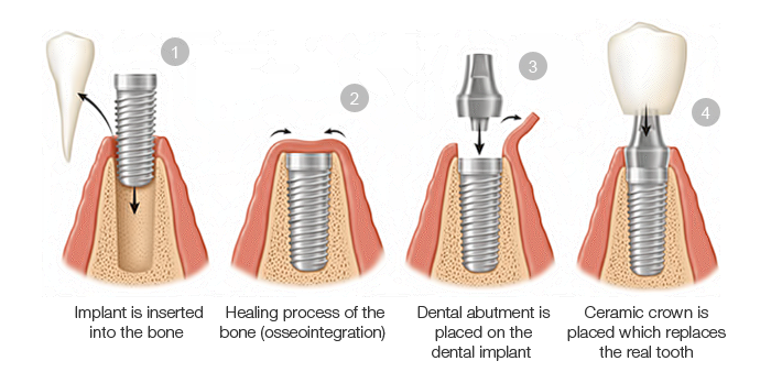 The Process Of Osseointegration With Dental Implants