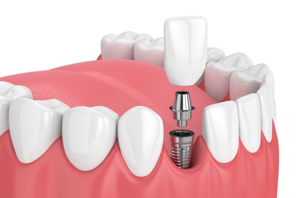 Dental Implants