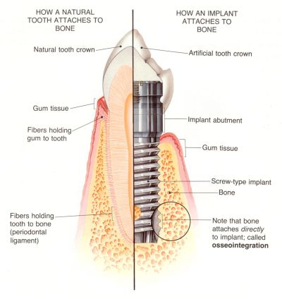 Osseointegration and Dental Implants A Comprehensive Guide