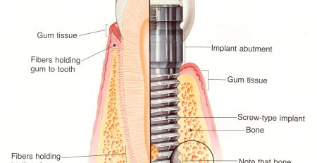 Osseointegration and Dental Implants A Comprehensive Guide