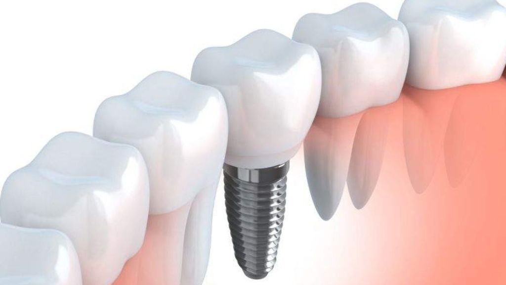 Post-Procedure Care After Getting A Dental Implant