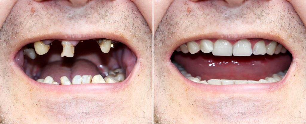 The Importance Of Replacing Missing Teeth