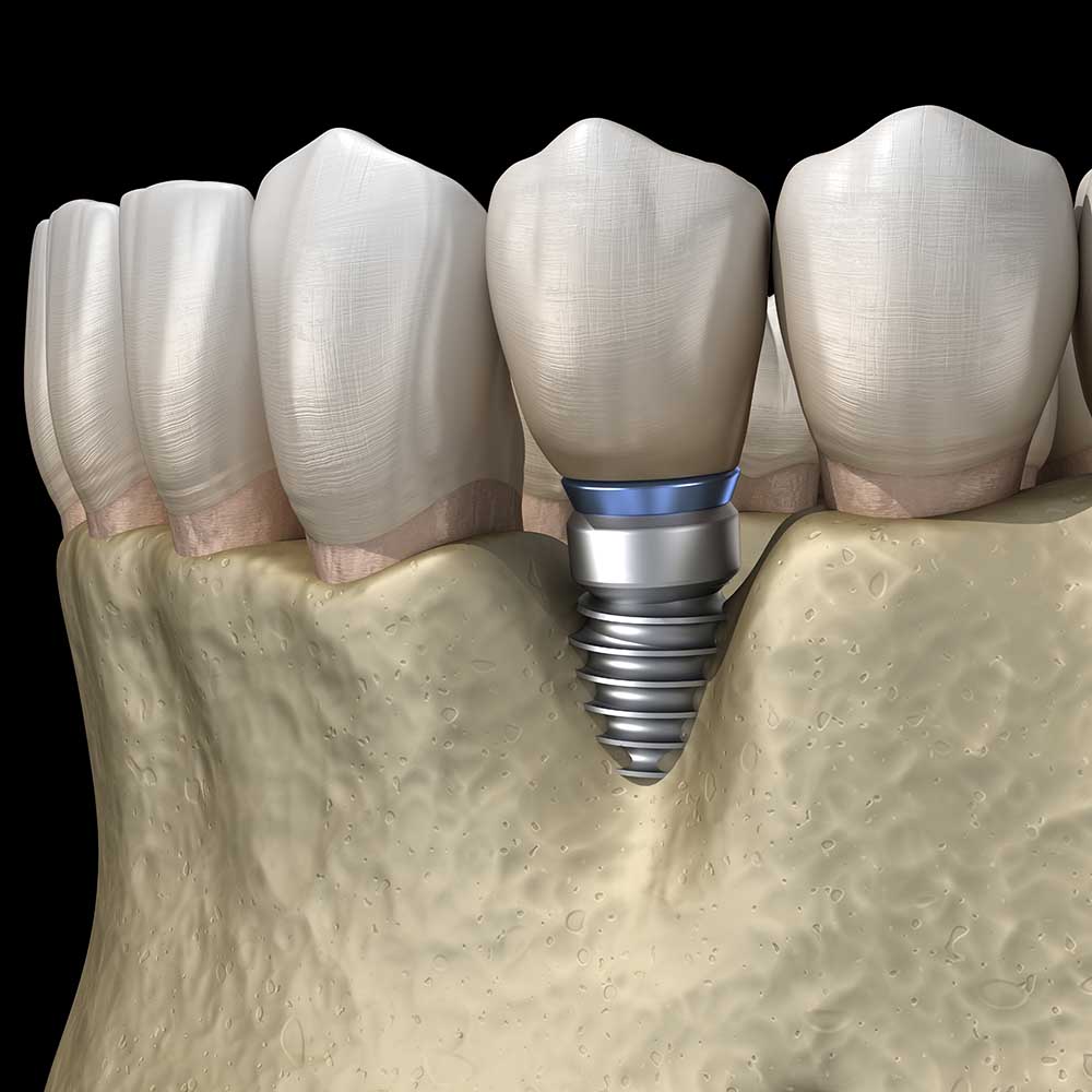 Treating Peri-Implantitis: Complications From Dental Implants