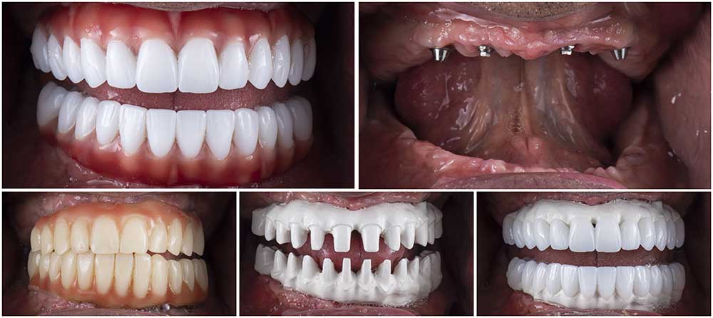 Treatment Options For Terminal Dentition - Full Mouth Rehabilitation