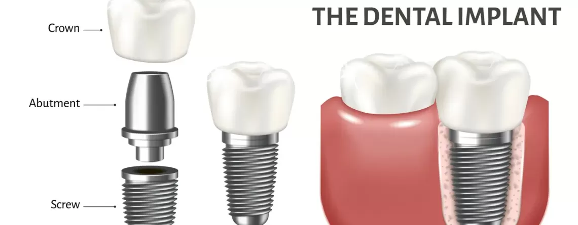 What are dental implants